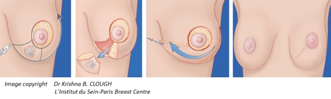 kuva-rintasyovan-leikkaus-suunnittelu