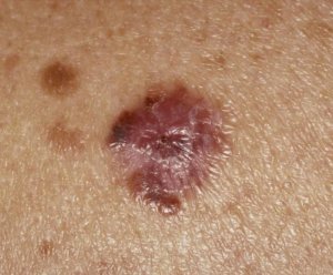 Esimerkki melanoomakasvaimesta